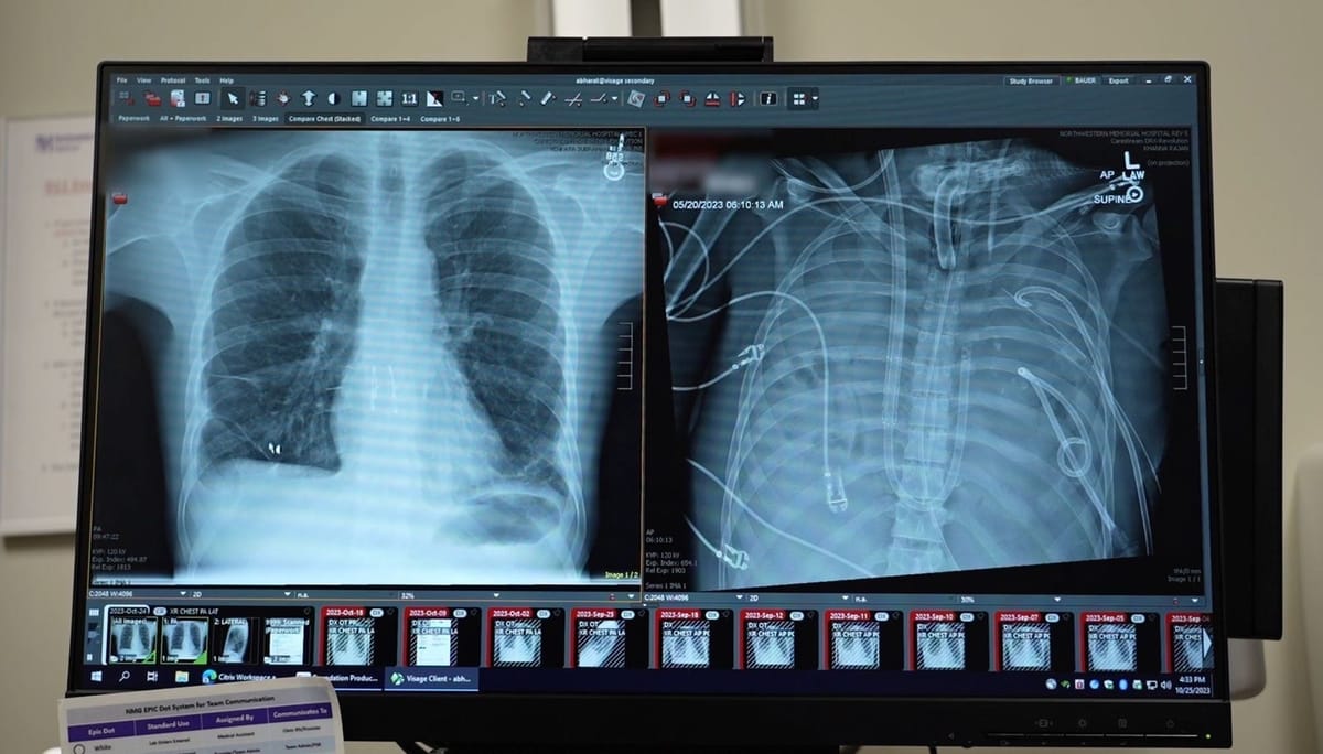 Artificial Lung Technology Keeps Patient Alive Until Transplant